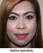 plastic_surgery_augmentation_rhinoplasty